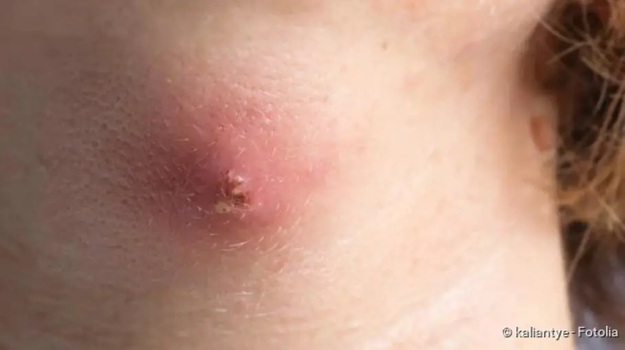It usually begins with a small, red "pimple" and then devel...