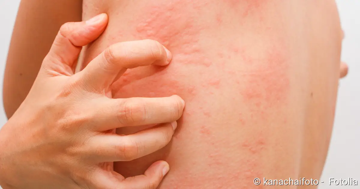 Hives Urticaria Symptoms Causes Diagnosis And Treatment Medical Society